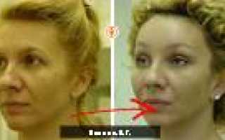 Подтяжка лица операция