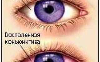 Чем лечить воспаление глаз