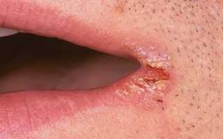 Заеды в уголках губ причины