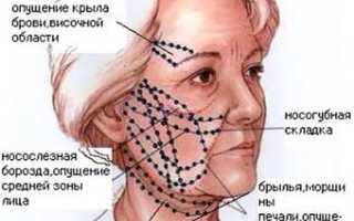 Лифтинговые нити