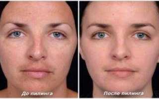 Лицо после чистки у косметолога