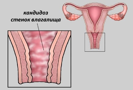 жжение и белые выделения у женщин